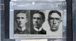 Lantern Slide: Acromegalia