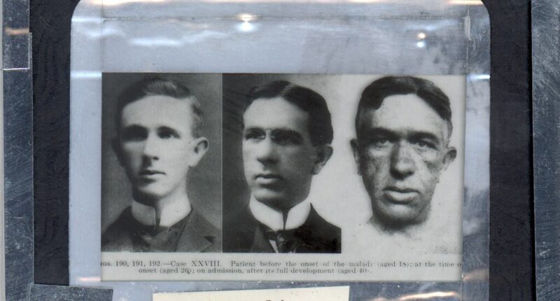 Lantern Slide: Acromegalia